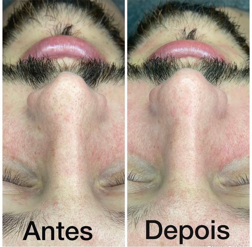 Limpeza de pele